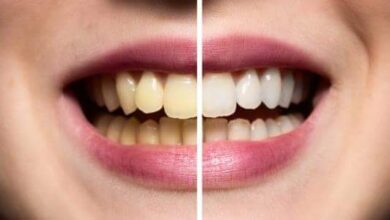كيفية جعل الاسنان بيضاء