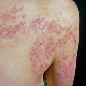 الامراض الجلدية الشائعة وانواعها