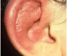 امراض الاذن الخارجية