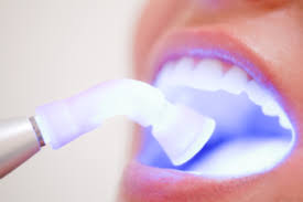 انظمة تبييض الاسنان