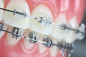 علاج تقويم الاسنان