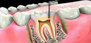 قناة جذر الأسنان