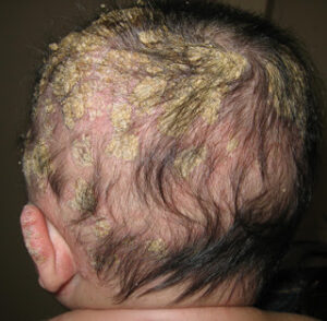 قشرة الشعر في الاطفال