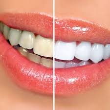 تغير لون الاسنان