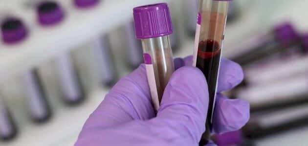 هل يظهر سرطان القولون في تحليل الدم